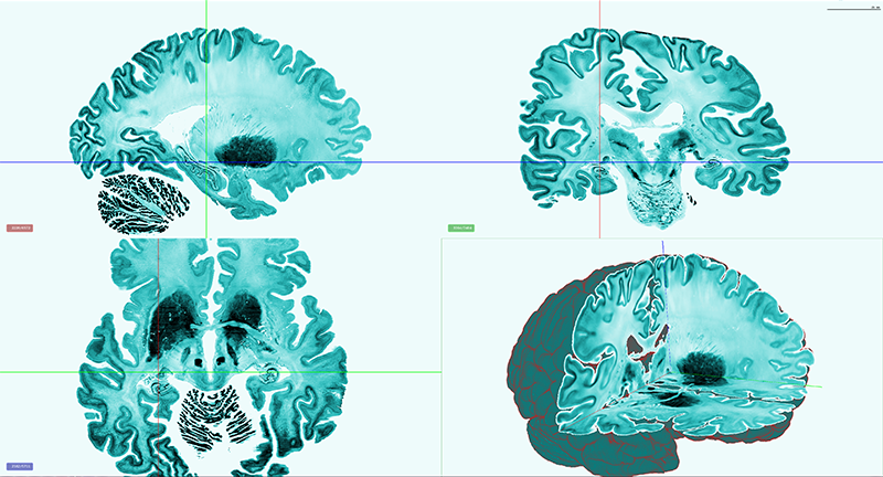 BigBrain: An Ultrahigh-Resolution 3D Human Brain Model